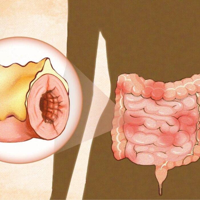 Crohn’s Disease: Symptoms, Causes, Treatments, and Natural Approaches