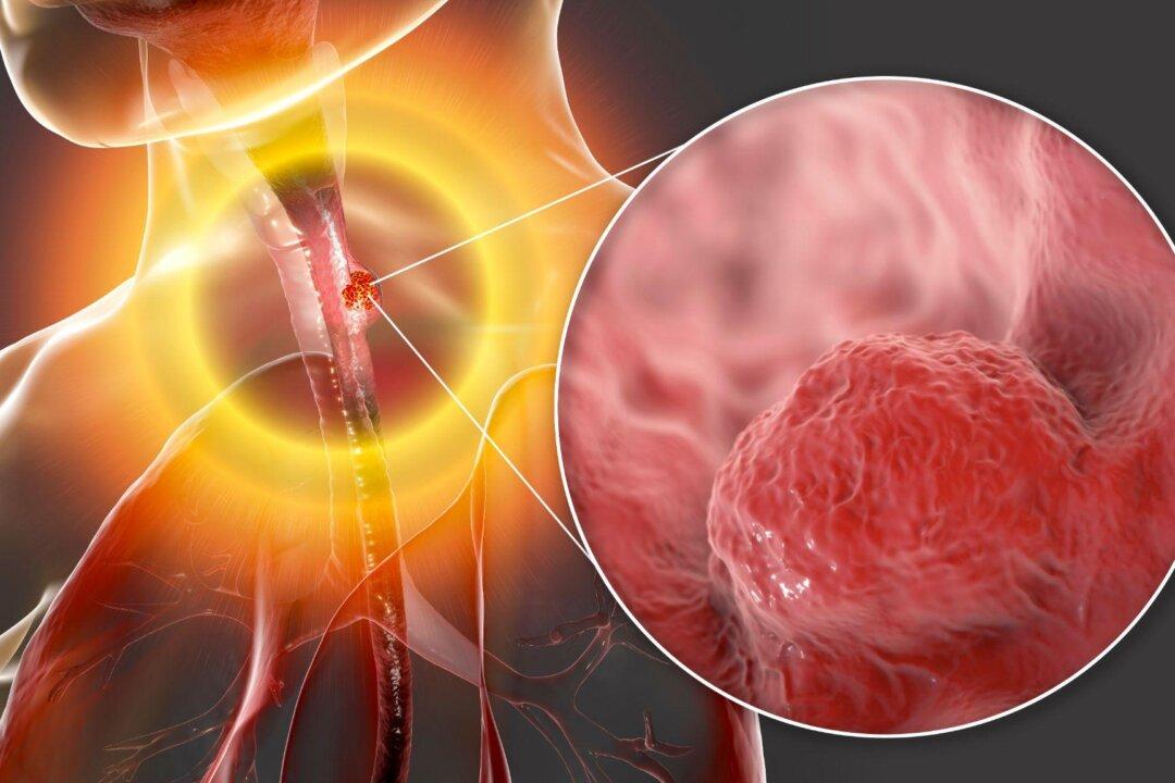 Watch Out for the Early Warning Signs of Esophageal Cancer