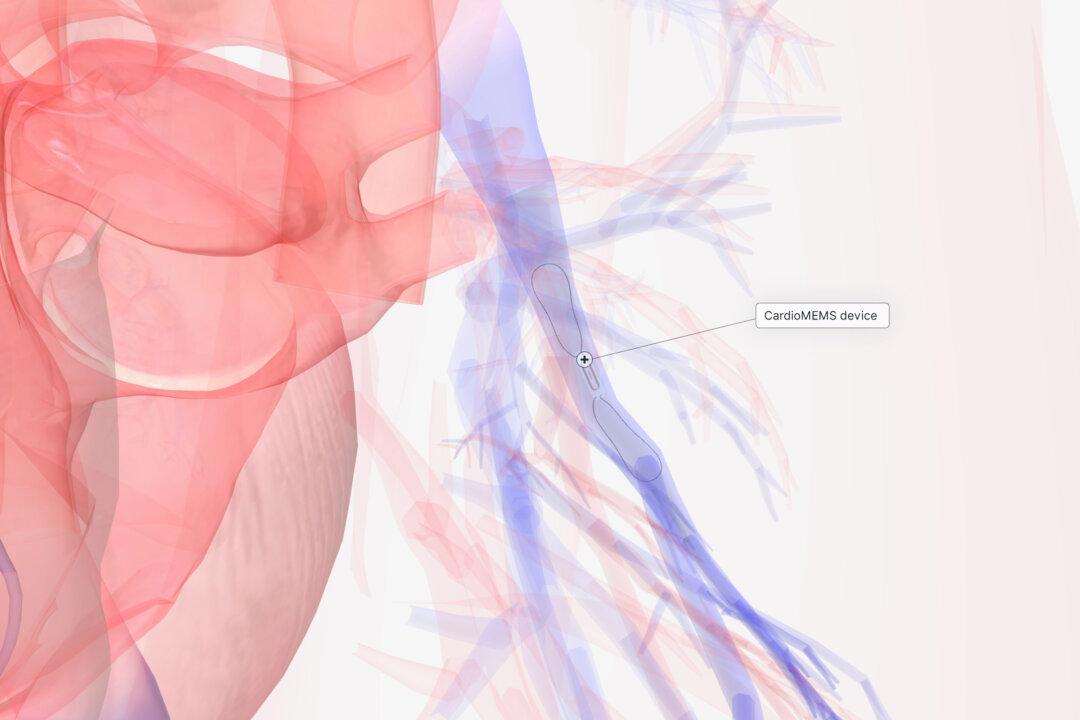 A Paper Clip-Sized Device Is Changing Heart Failure Treatment