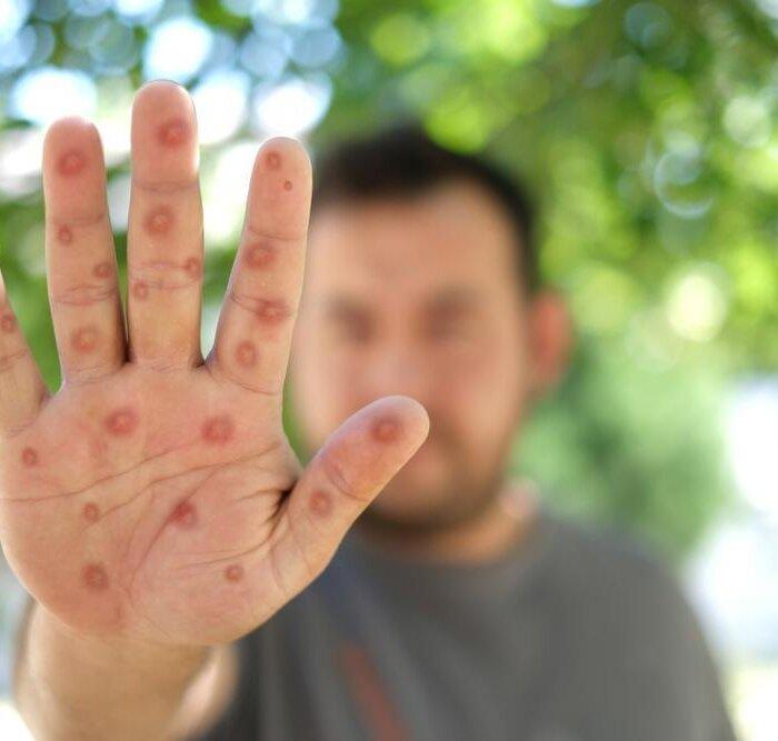 Health Advisory on Monkeypox Outbreak