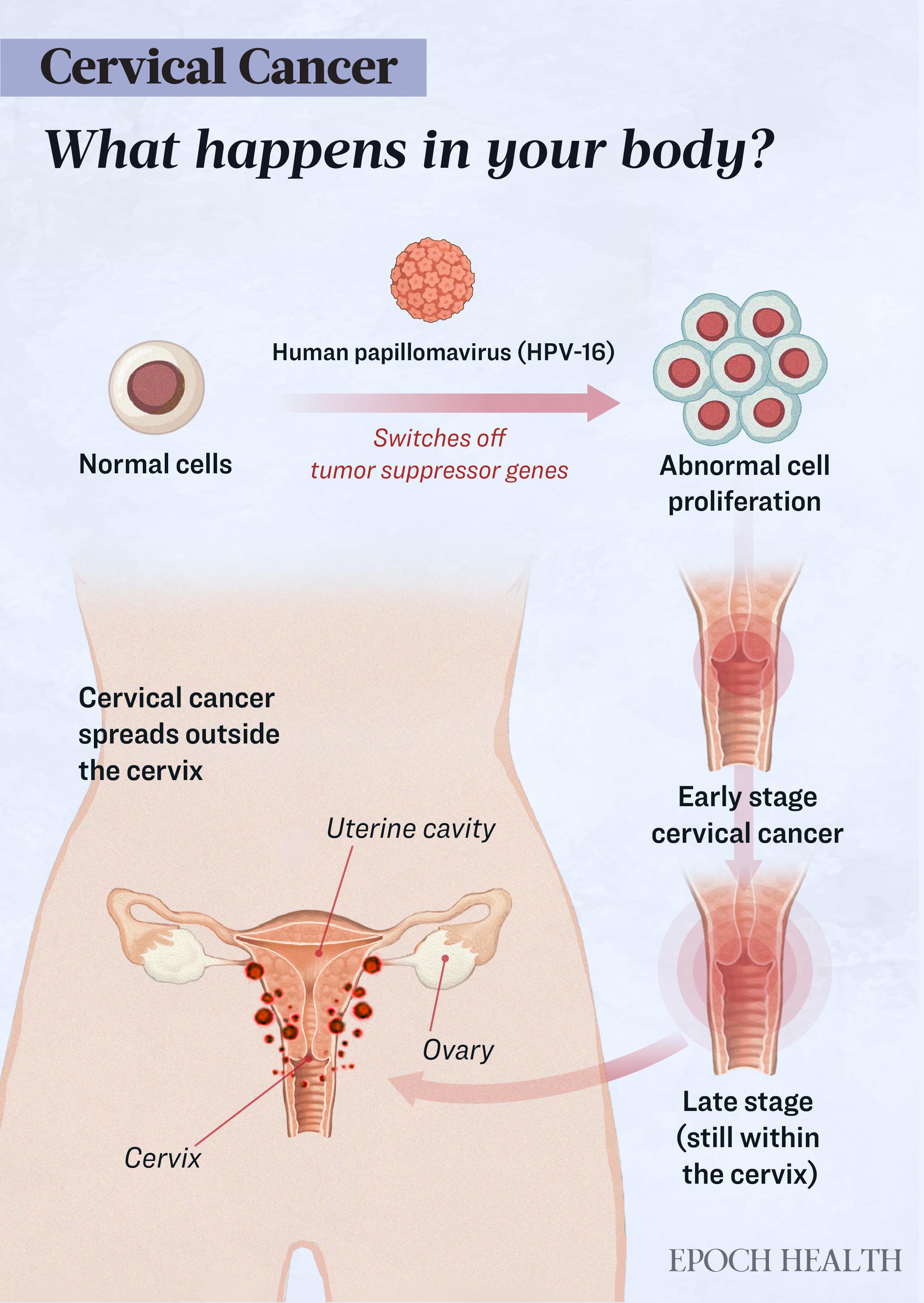 Cervical Cancer: Symptoms, Causes, Treatments, and Natural Approaches | USNN World News image-5727789