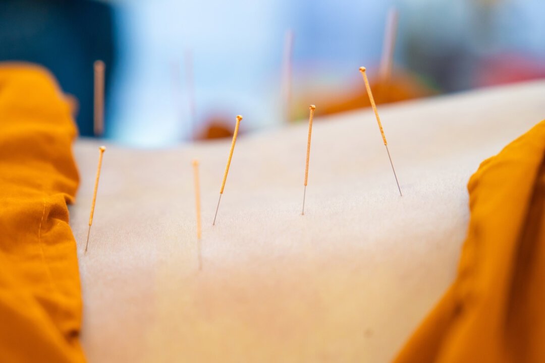 Acupuncture Treats Chronic Pain, Headaches, etc.