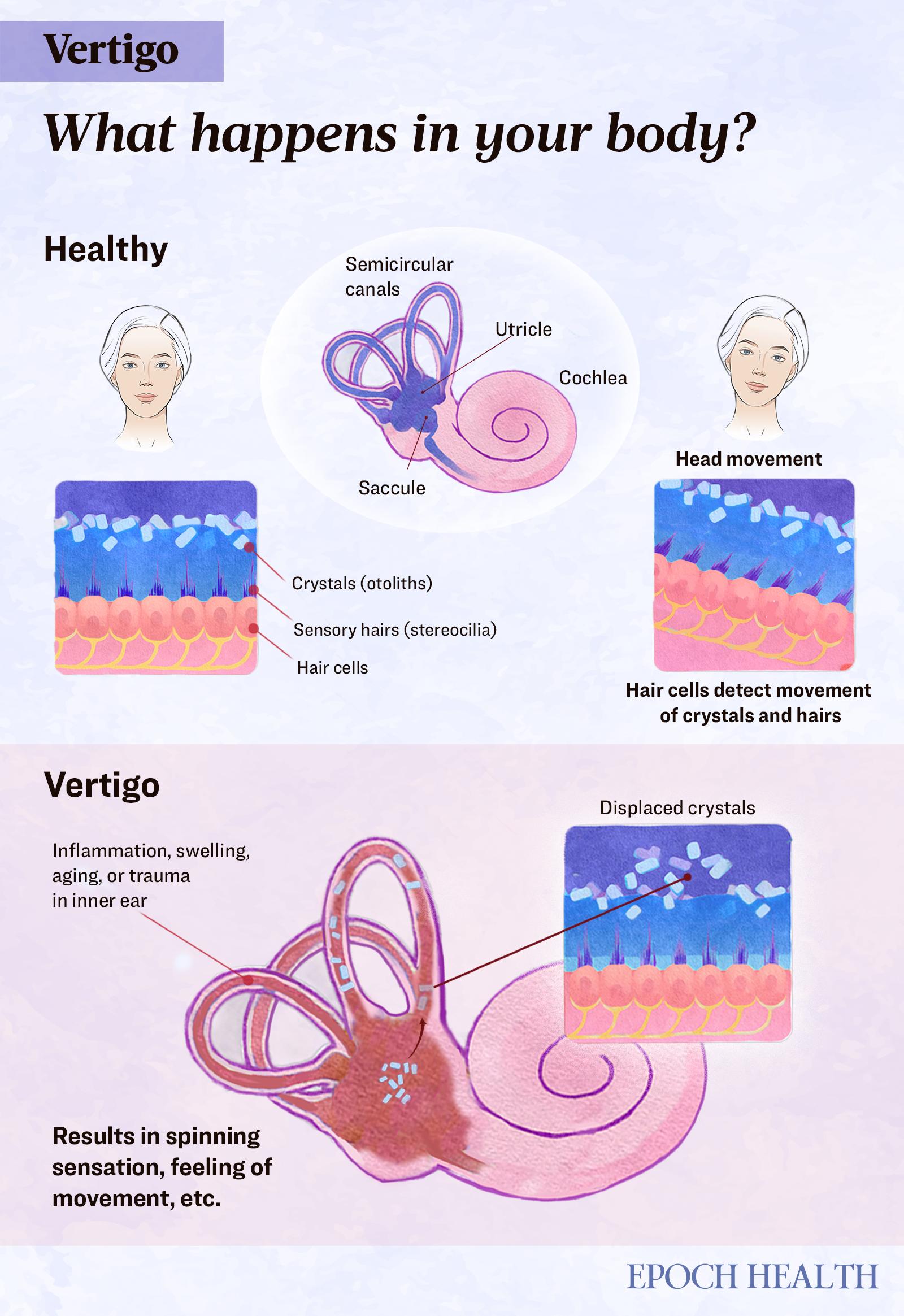 Vertigo: Symptoms, Causes, Treatments, and Natural Approaches | USNN World News image-5765101