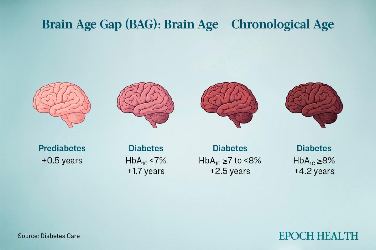Differences in brain aging among patients with varying degrees of diabetes. (The Epoch Times)