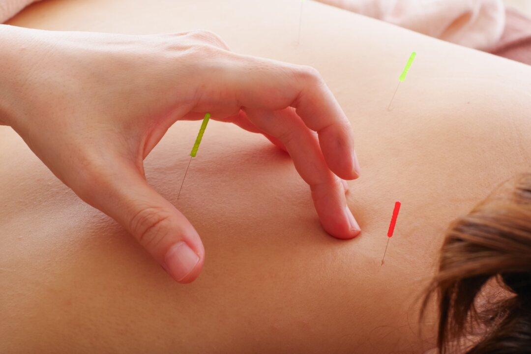 Acupuncture Proven Effective for Sciatica: Clinical Trial