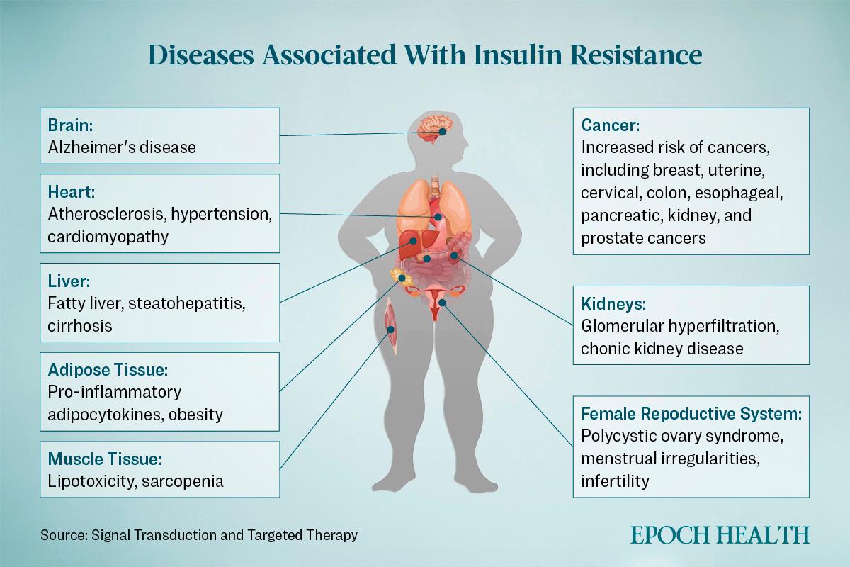 Diseases linked to insulin resistance. (Source: Signal Transduction and Targeted Therapy)