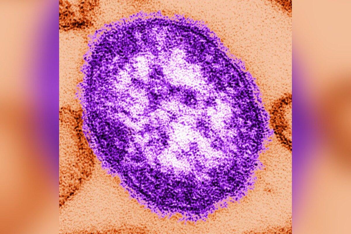 This undated image made available by the Centers for Disease Control and Prevention shows an electron microscope image of a measles virus particle on Feb. 4, 2015. (The Canadian Press/AP-Cynthia Goldsmith/Centers for Disease Control and Prevention via AP)