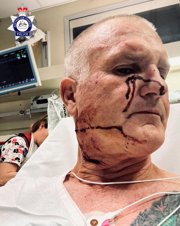 The injured AFP officer after he was allegedly assaulted with a pen by a woman he was taking off a Jetstar flight at Perth airport. (Supplied | AFP)