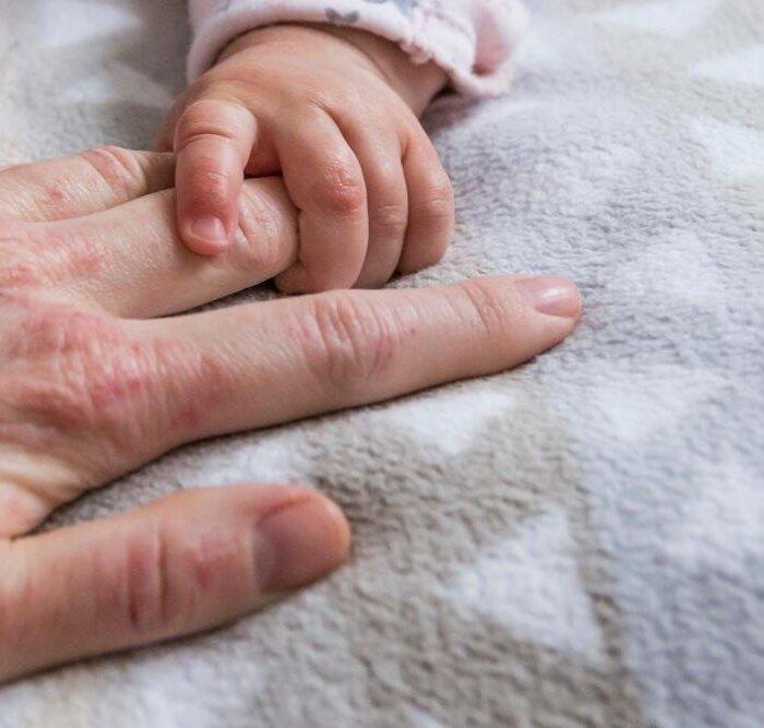 Ancient, Natural Remedies for Managing Recurrent Eczema