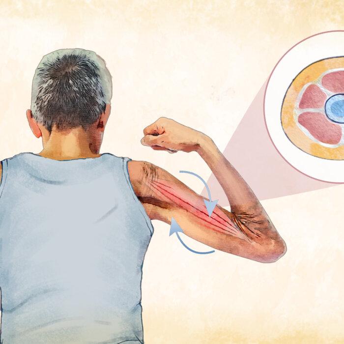 Sarcopenia: Symptoms, Causes, Treatments, and Natural Approaches