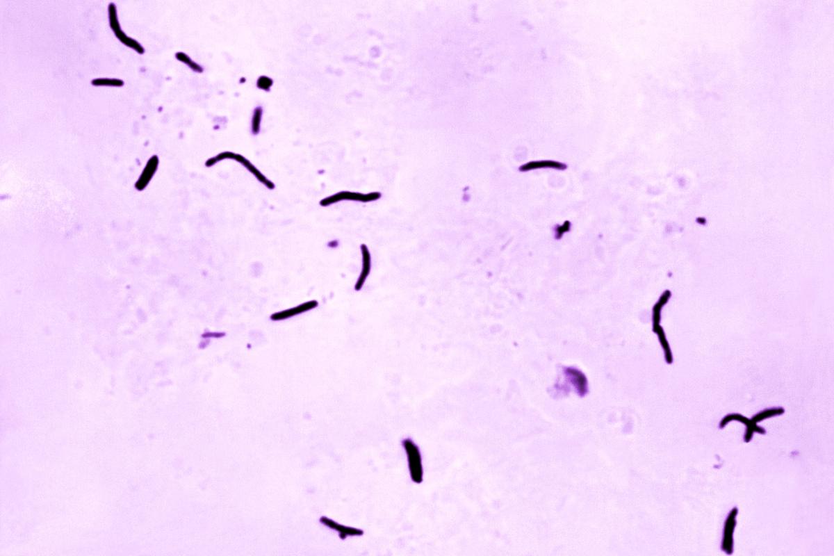 2 Dead, Dozens Sick in Tuberculosis Outbreak in Kansas City Area