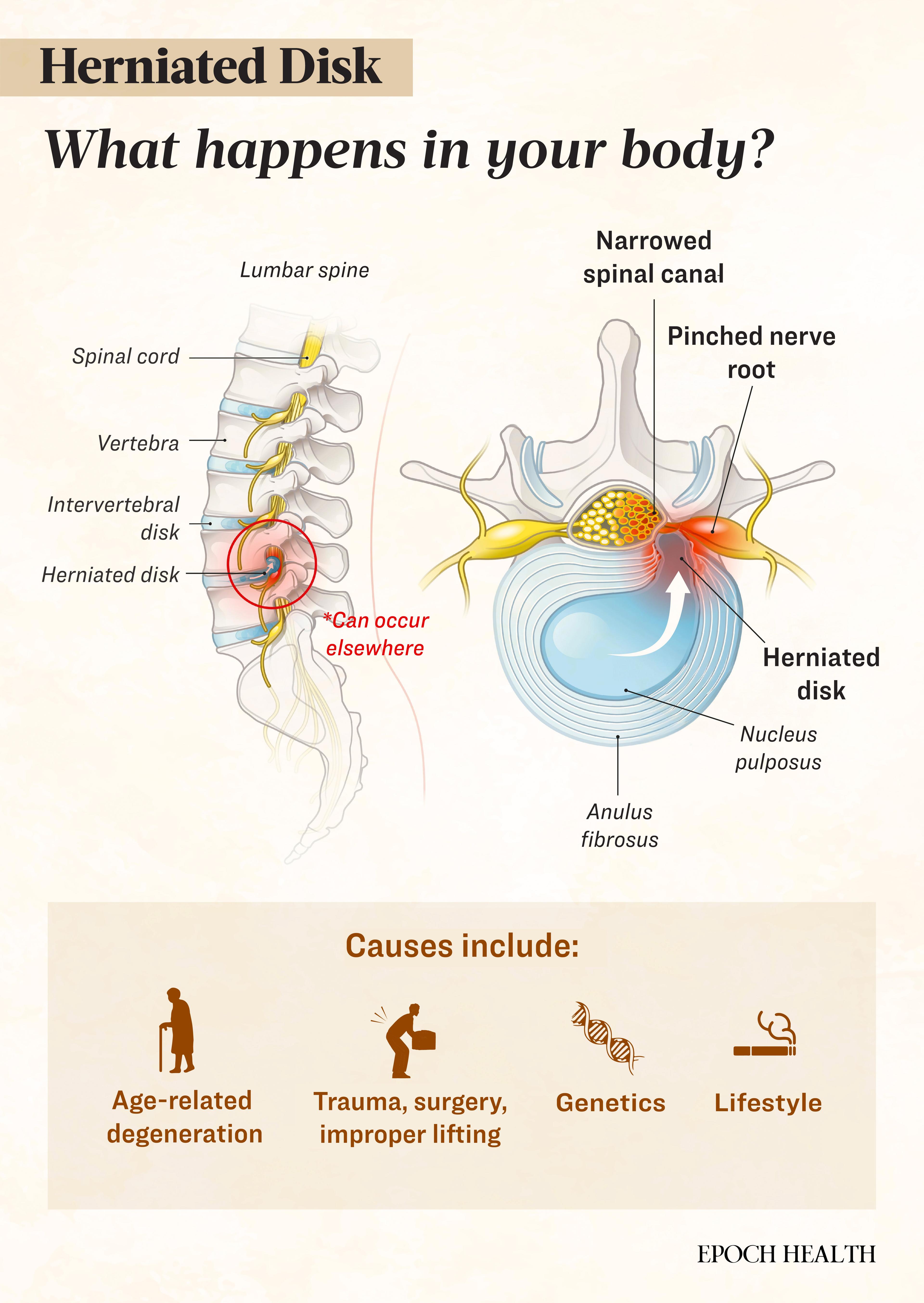 Herniated Disk: Symptoms, Causes, Treatments, and Natural Approaches | USNN World News Herniated Disk: Symptoms, Causes, Treatments, and Natural Approaches | USNN World News