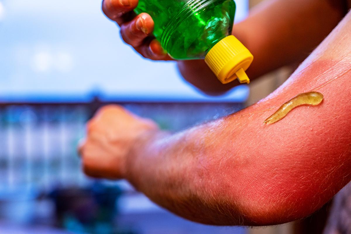 Sunburn’s Real Culprit: It’s Not DNA Damage