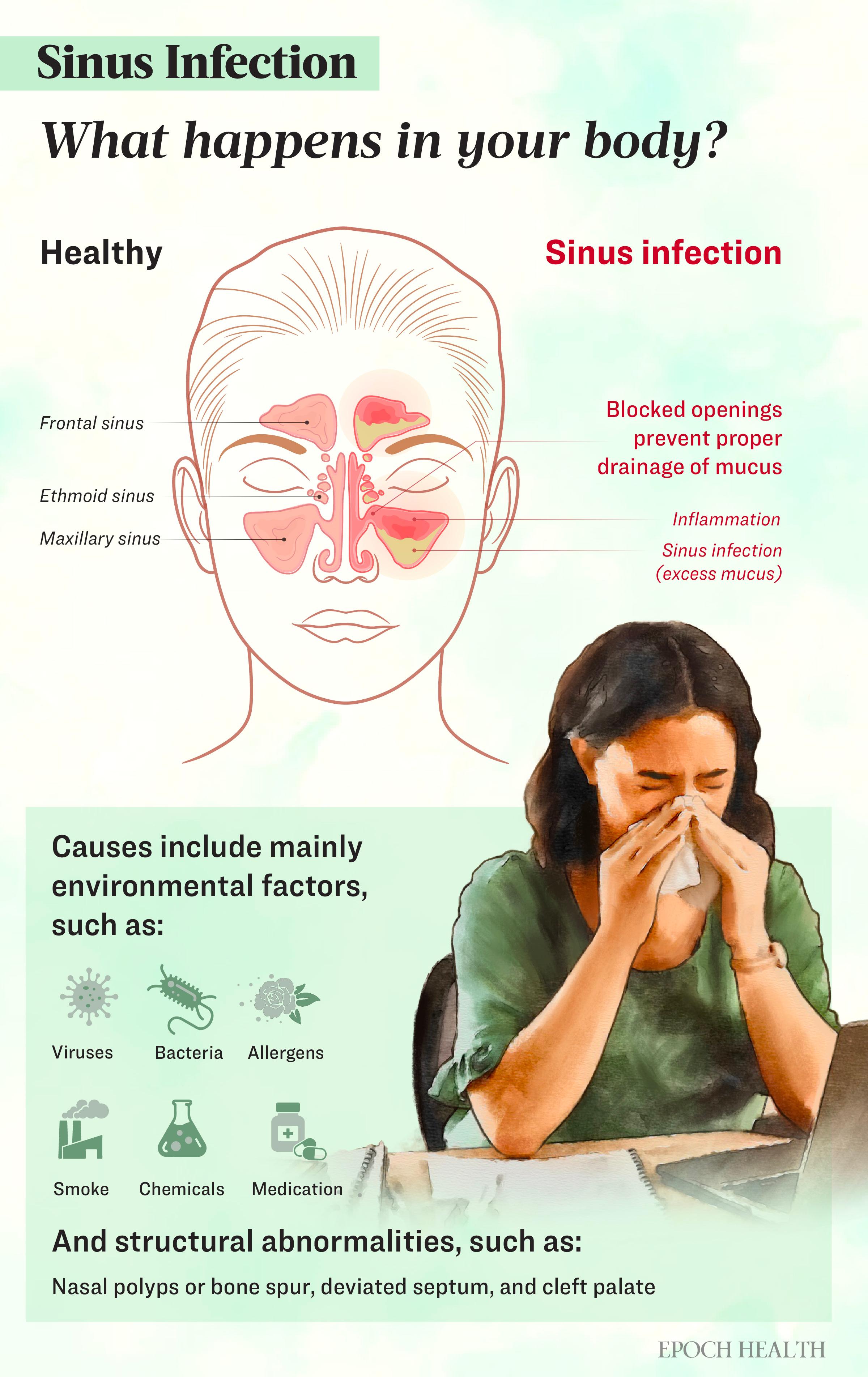 Sinus Infection: Symptoms, Causes, Treatments, and Natural Approaches | USNN World News image-5805748