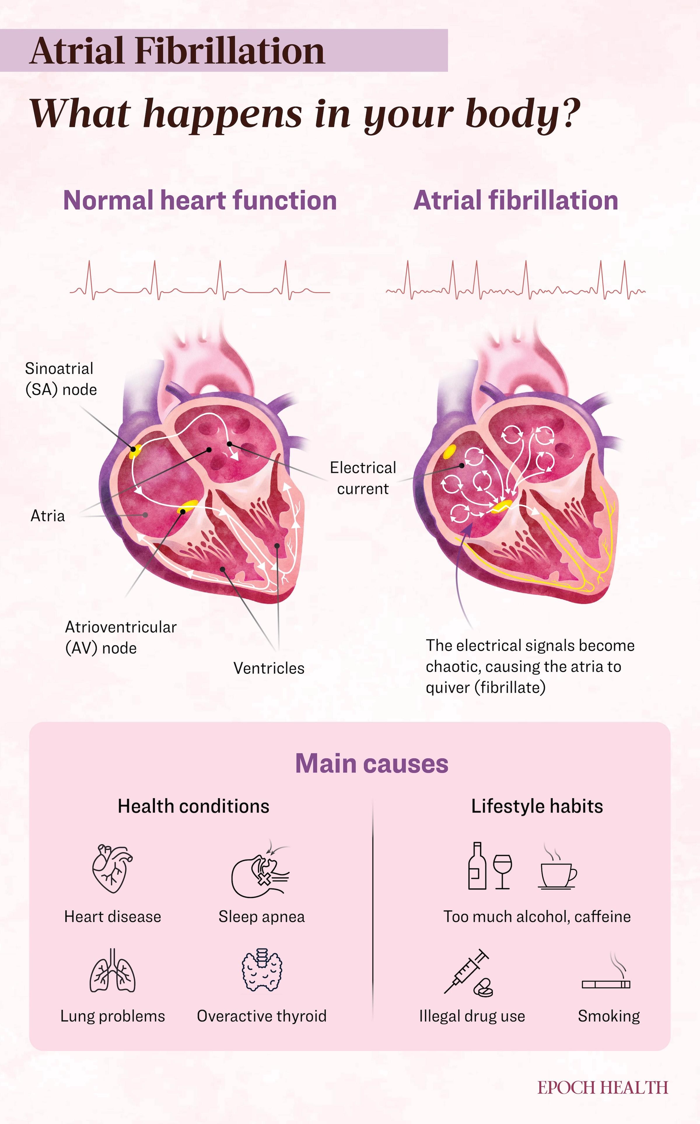 Atrial Fibrillation: Symptoms, Causes, Treatments, and Natural Approaches | USNN World News image-5814392