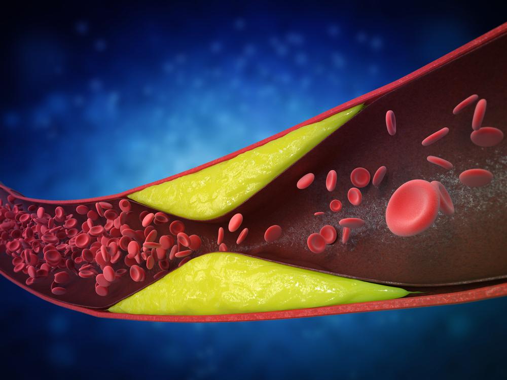 Protecting Your Heart: How High Cholesterol and Emotional Health Affect Atherosclerosis