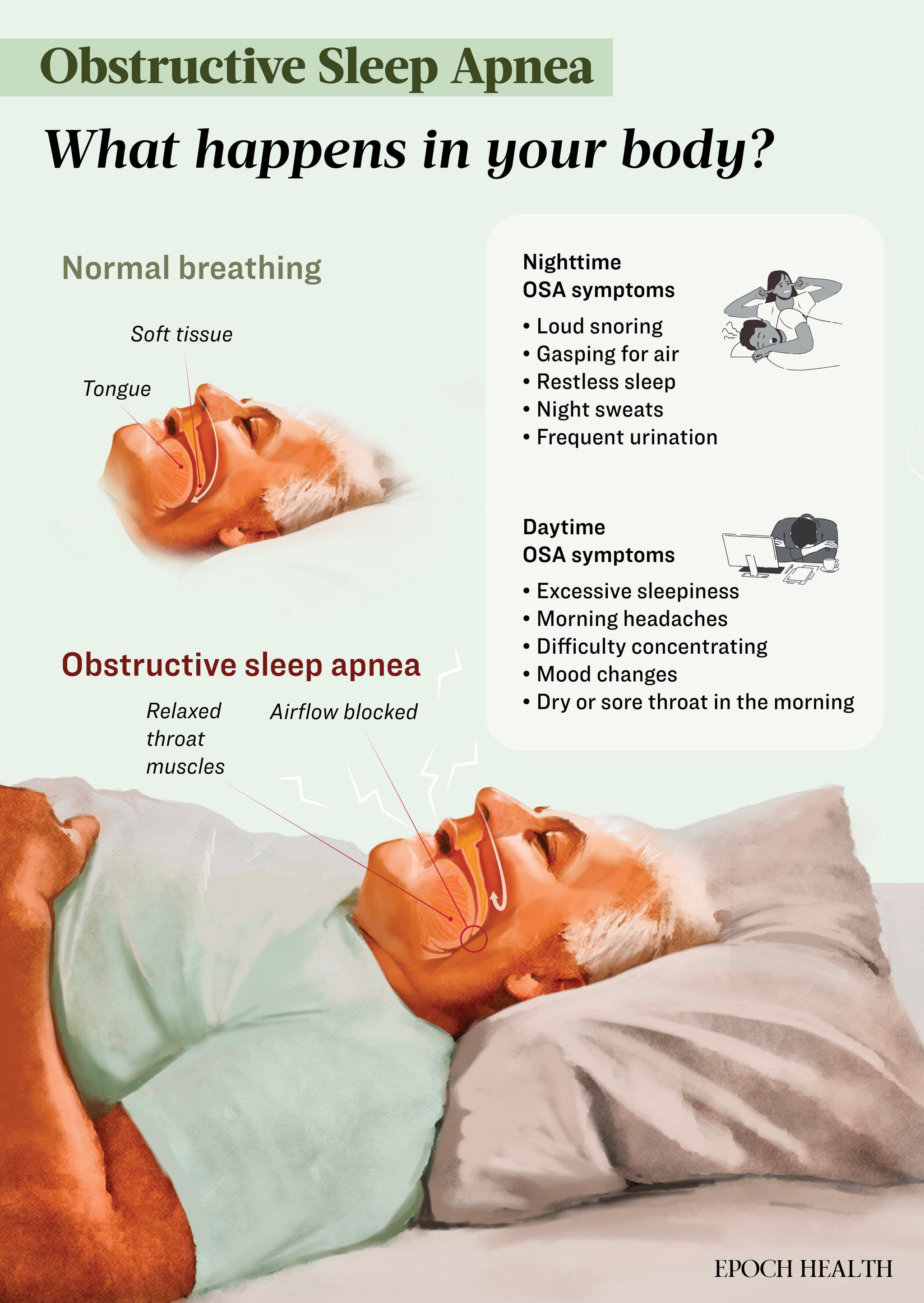 在阻塞性睡眠呼吸暂停中,放松的喉部肌肉会导致舌头和软组织阻塞睡眠时的气流。 (Shutterstock/大纪元制图)