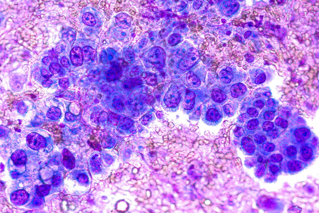 Sugar Stores in the Body May Fuel Common Lung Cancer Progression: Study