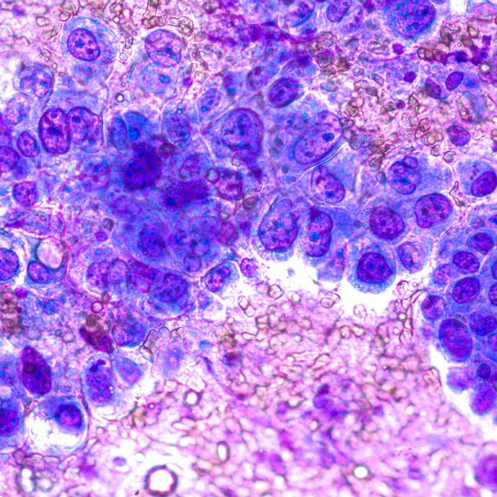 Sugar Stores in the Body May Fuel Common Lung Cancer Progression: Study