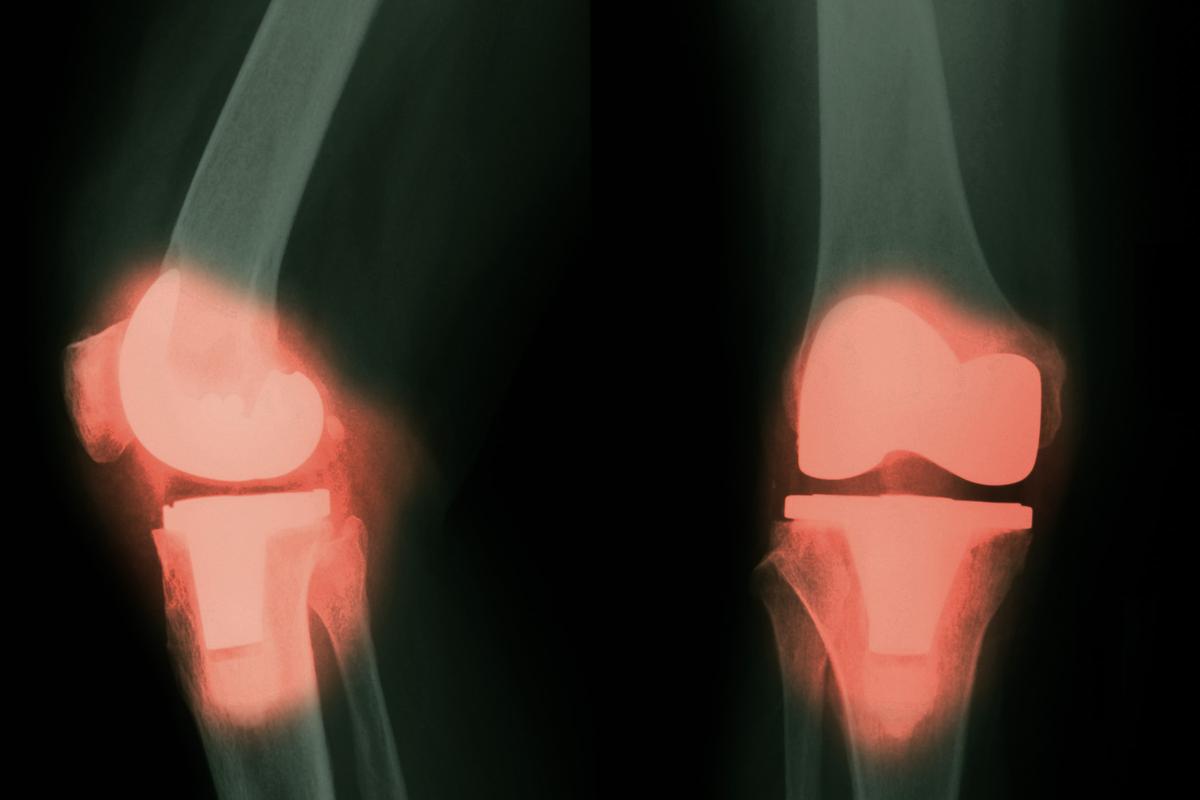 Metal From Joint Implants May Enter the Blood and Brain: Study