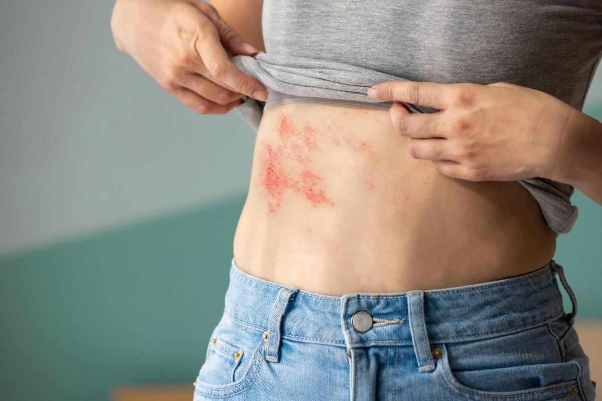 Healing Shingles Naturally: Herbal Recipes to Boost Immunity and Protect Your Nerves