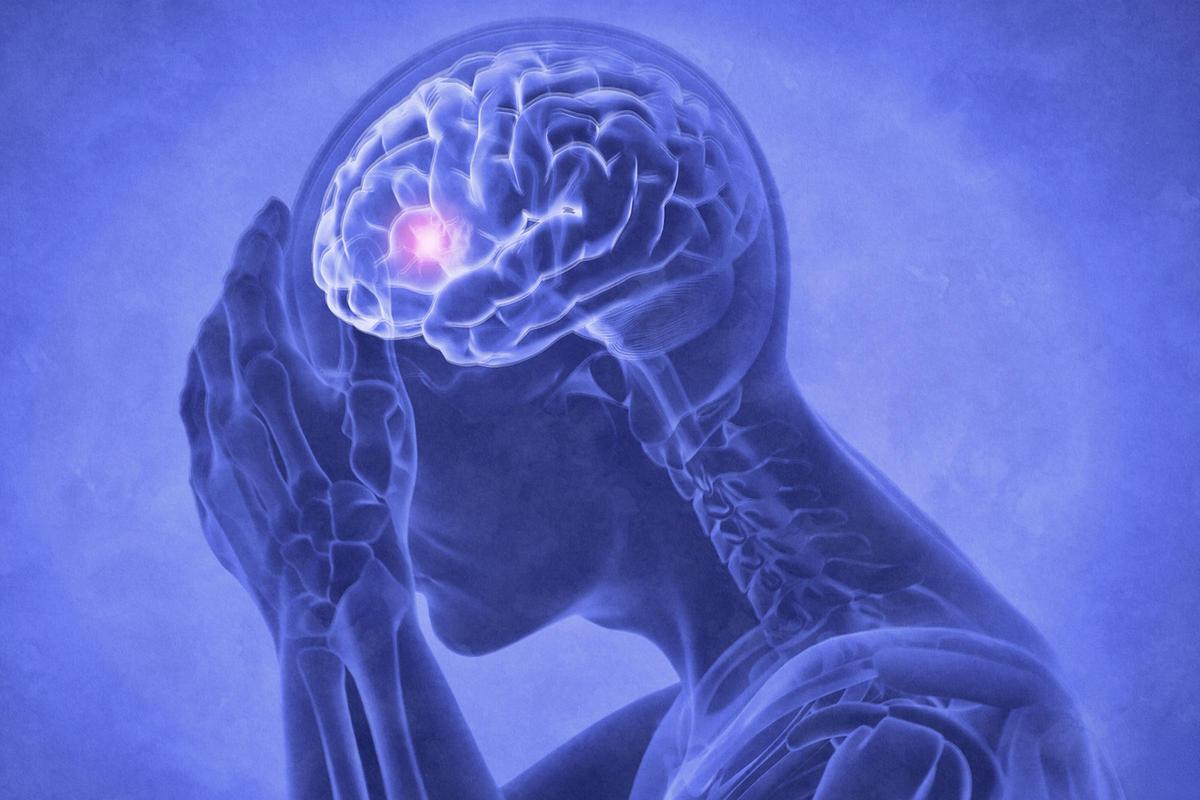 The Unrecognized Link Between Mini-Strokes and Lasting Fatigue