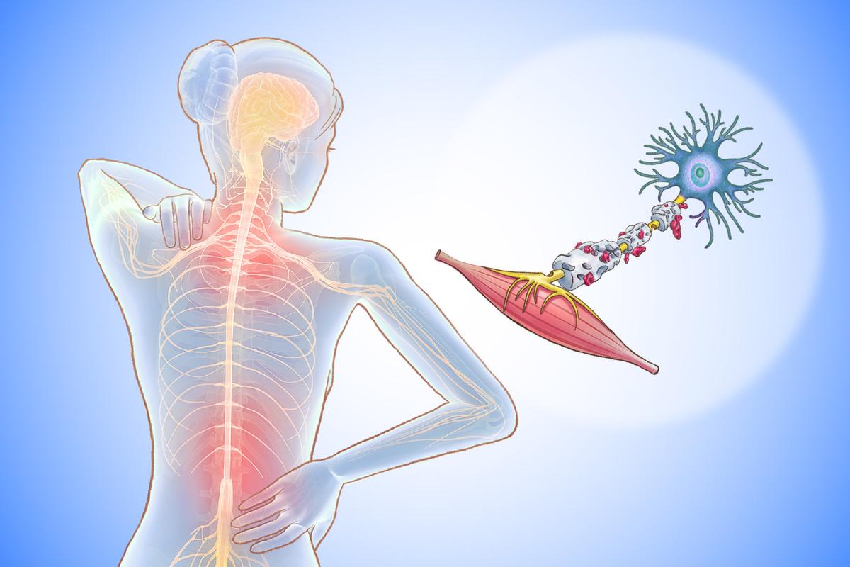 Multiple Sclerosis: A Debilitating Autoimmune Disease and Its Early Signs