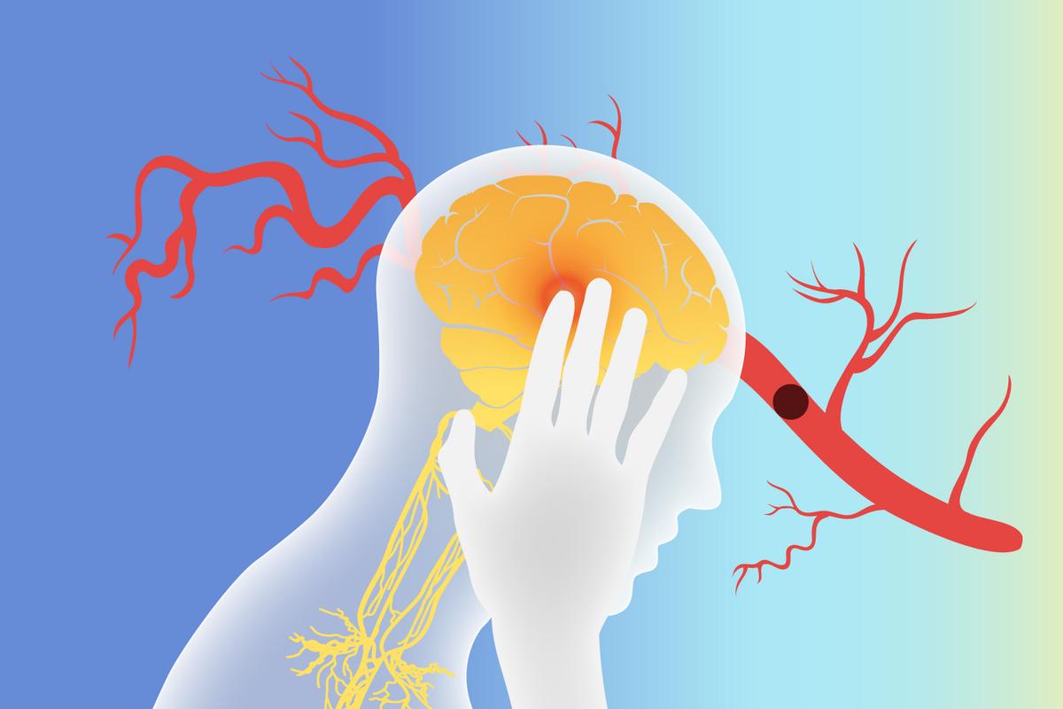 Stimulating the Vagus Nerve May Help With Stroke Recovery—Here’s How