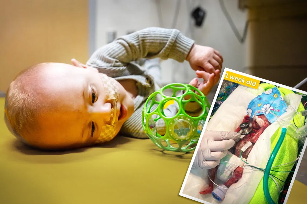 Baby Born Weighing Less Than Can of Soda Breaks Guinness Record for Most Premature After Turning 1
