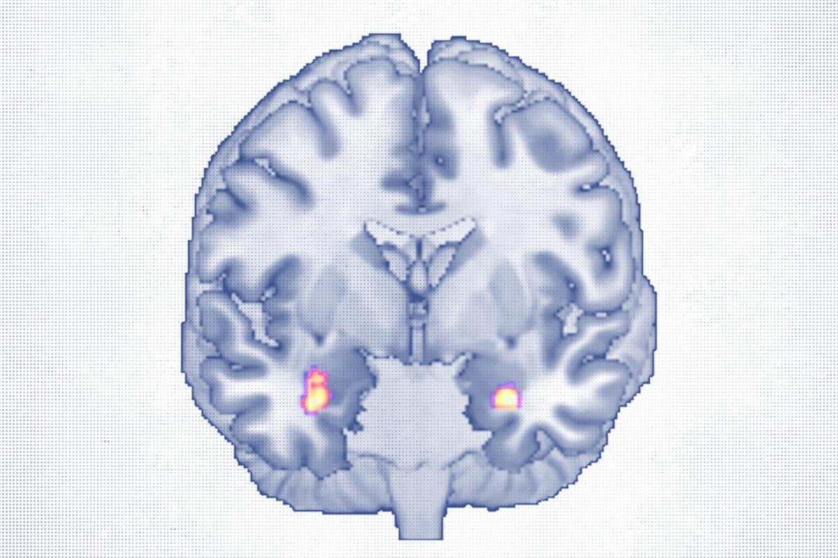 Cognitive Behavioral Therapy Reshapes Brain Structure