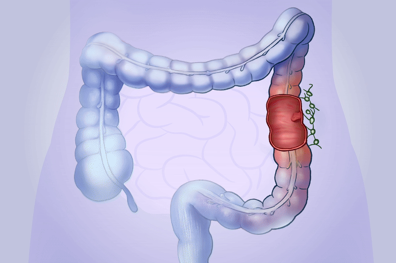 Colon Cancer: How Harmless Polyps Can Turn Dangerous–Here Are the Early Signs