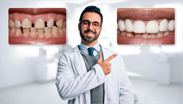 Shiny Smile Veneers