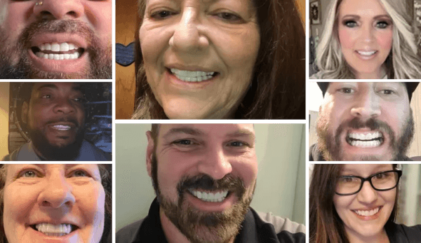Shiny Smile Veneers