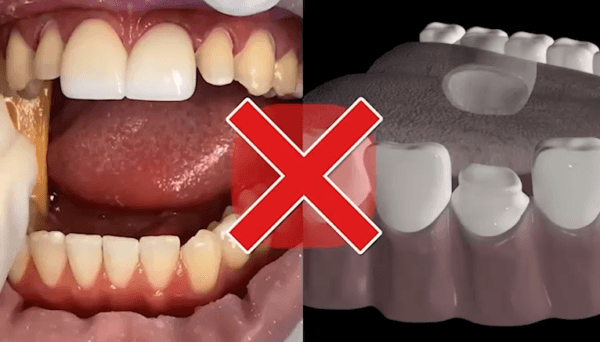 Shiny Smile Veneers