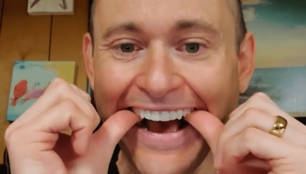 Shiny Smile Veneers