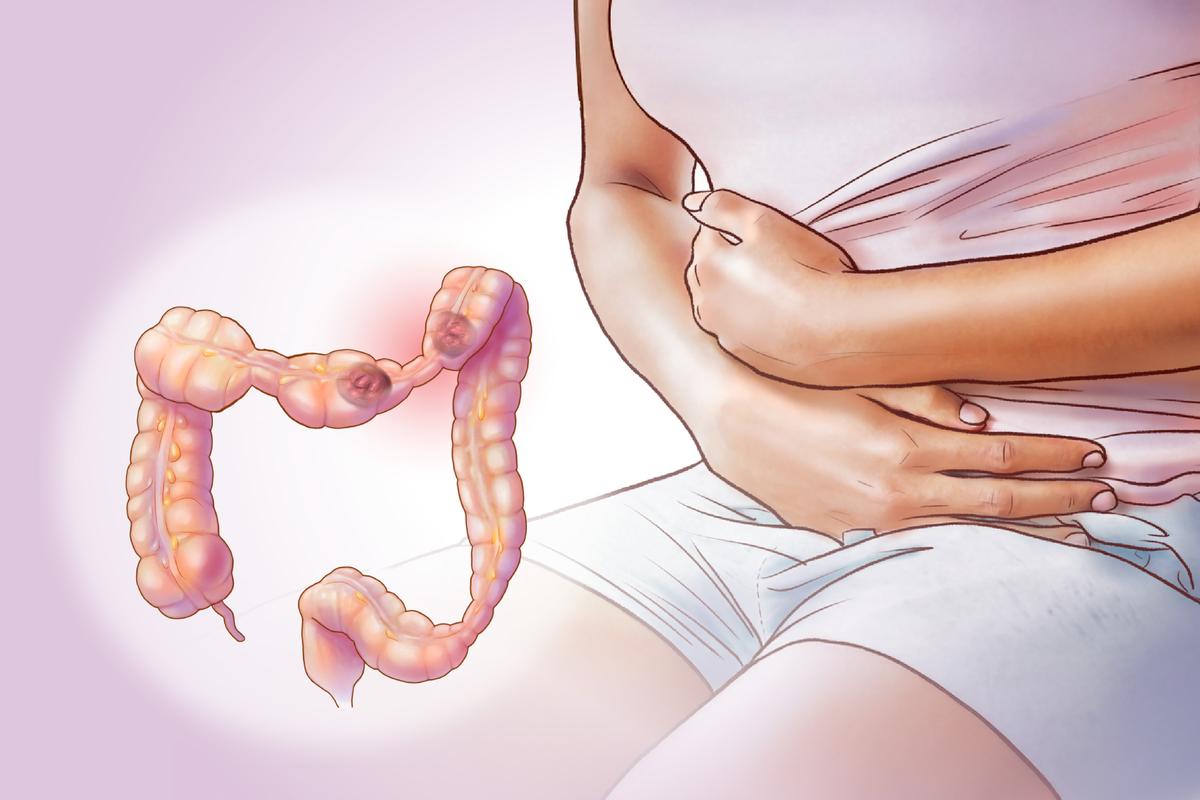Irritable Bowel Syndrome: Most Common Gut Disorder–Key Symptoms to Watch For