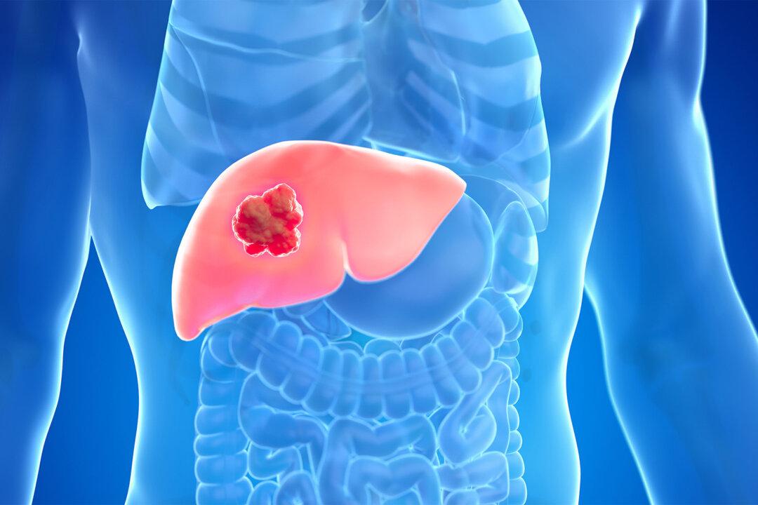 60 Percent of Liver Cancer Can Be Prevented—Here’s How