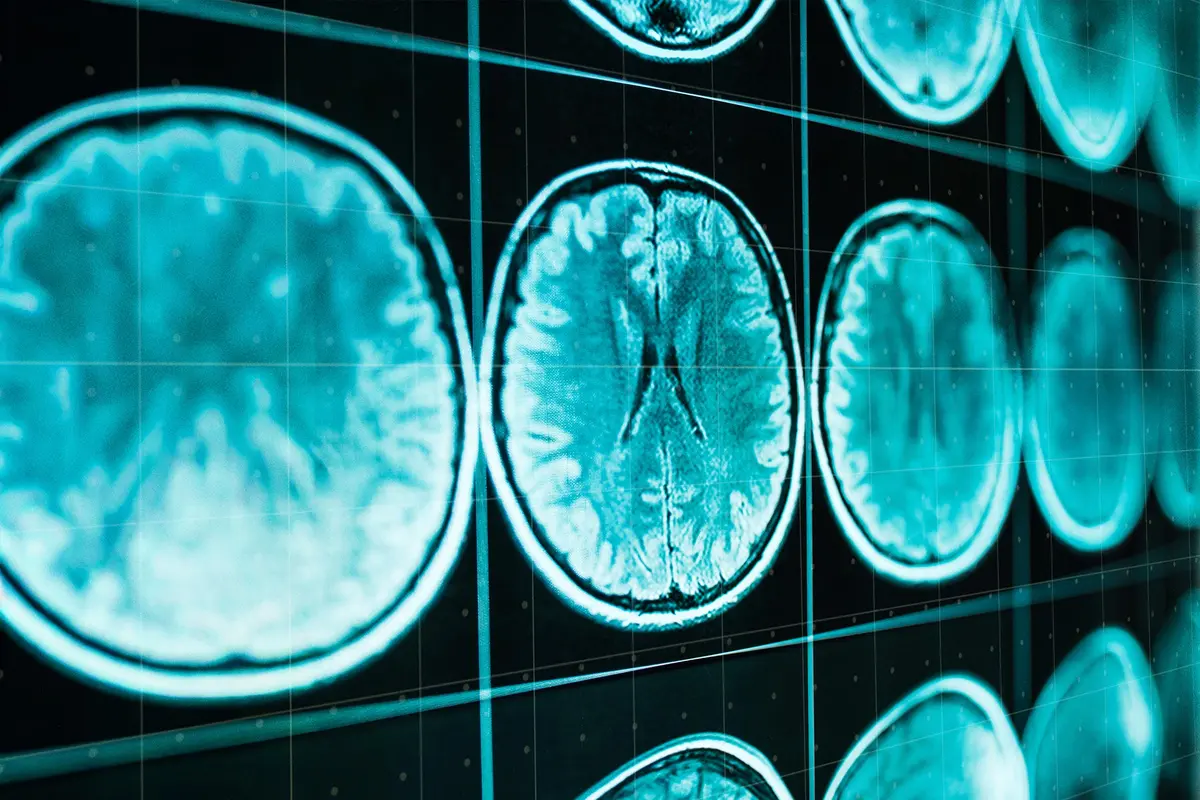 Why Does Dementia Take So Long to Diagnose? thumbnail