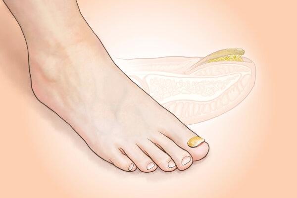 Toenail Fungus: A Stubborn Infection Affecting 1 in 10 People–Signs to Watch For