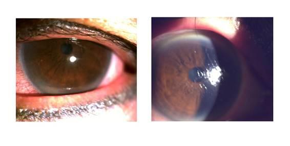 (Derecha) Paciente con queratitis filamentosa severa. La córnea perdió su brillo y le costó abrir los ojos. (Izquierda) Tras el tratamiento, la córnea se volvió lisa y brillante. (Cortesía del Dr. Wang Meng-Chi, Centro de Oftalmología Confía en mí)