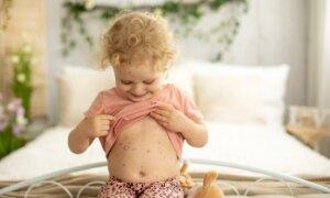 The Chicken Pox Controversy