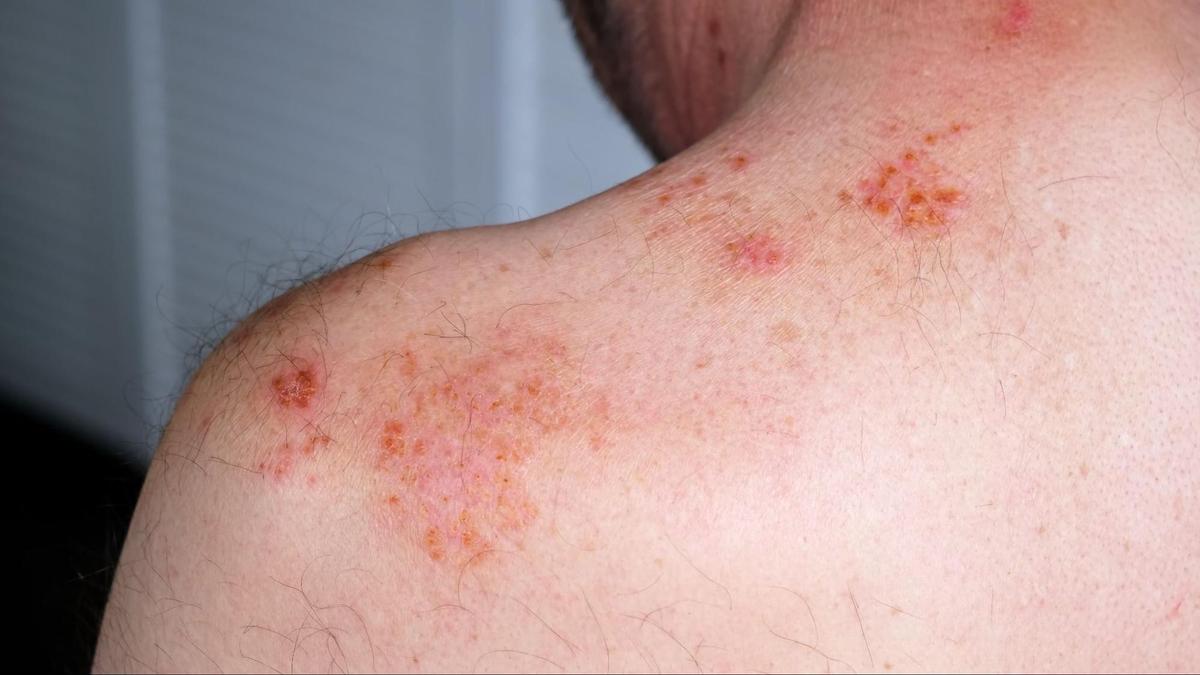 When Stress Shows on Your Skin: From Sudden Hair Loss to Chronic Inflammation