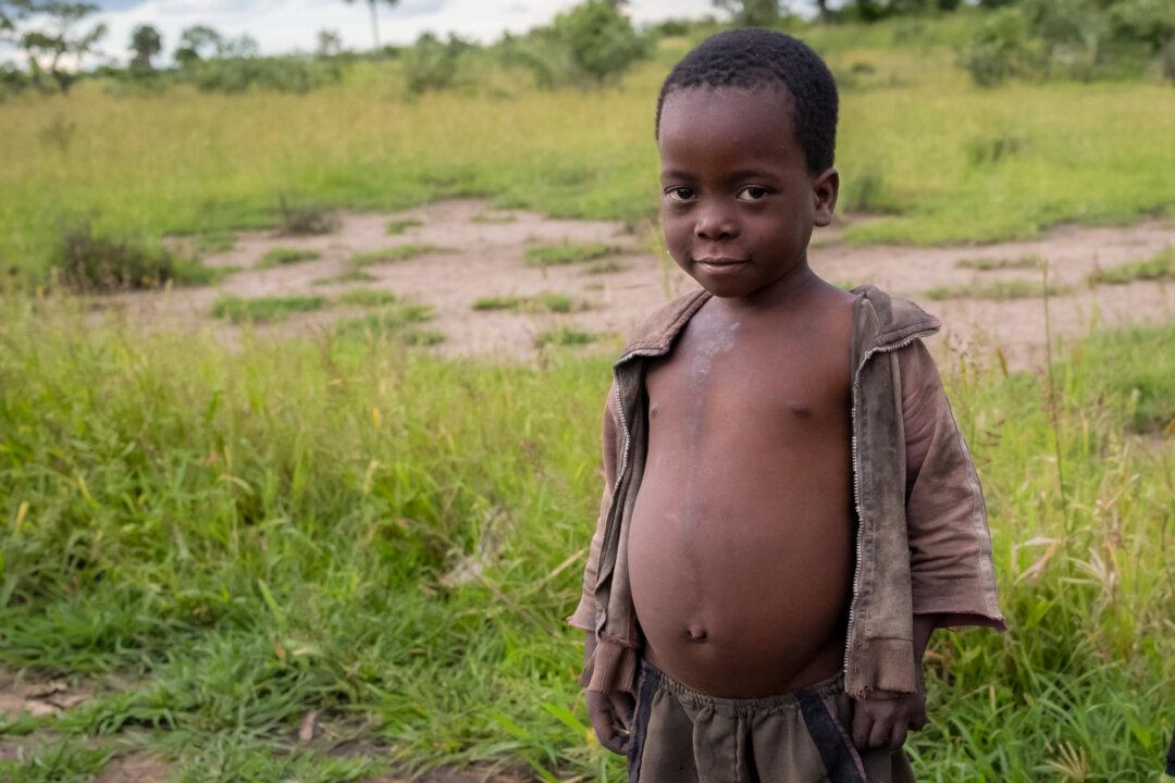 A child with a swollen belly due to a severe lack of food stands outside of Monkey Bay, Malawi, on Feb. 18, 2026. (John Fredricks/The Epoch Times)