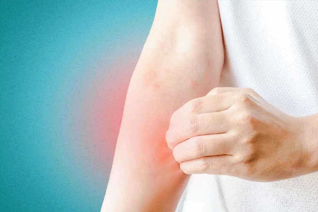 Urticaria, Eczema, and Shingles: How TCM Remedies Soothe Seasonal Skin Problems