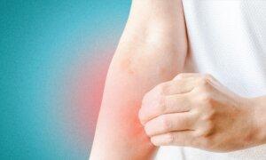Urticaria, Eczema, and Shingles: How TCM Remedies Soothe Seasonal Skin Problems