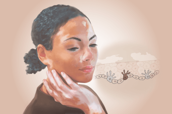 Vitiligo: The Autoimmune Condition That Turns Skin Against Itself–Here Are the Causes