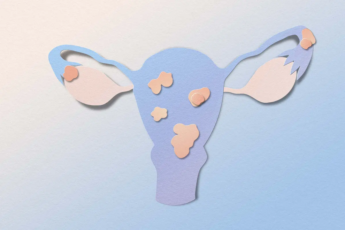 New Noninvasive Imaging Could Cut Years Off Endometriosis Diagnosis