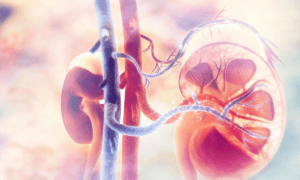 Millions of Chronic Kidney Disease Cases Remain Undiagnosed, Study Finds