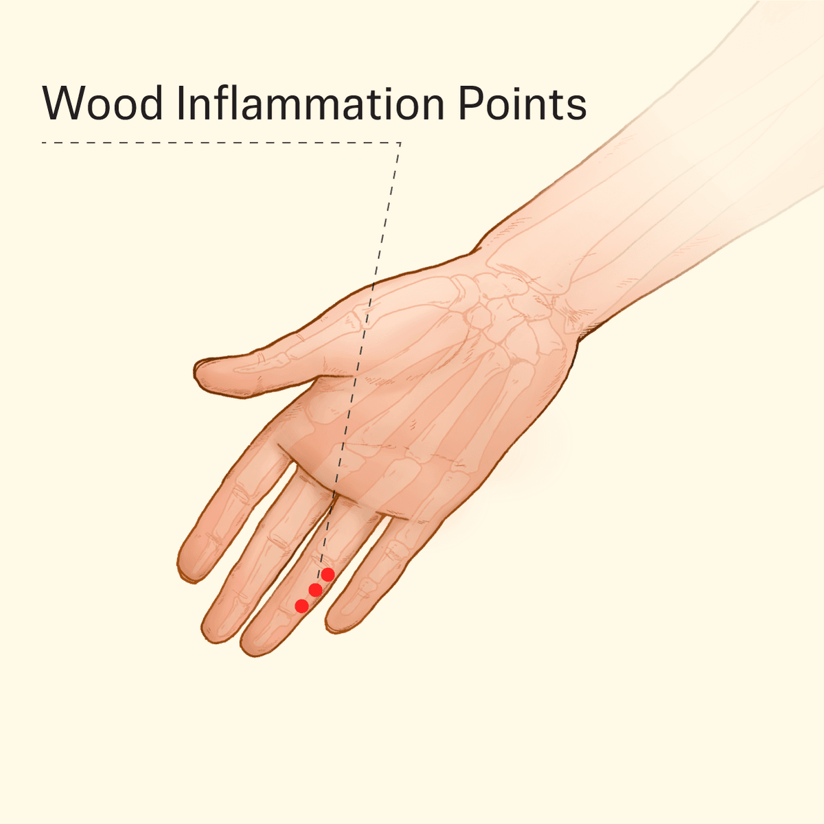 Location of the Wood Inflammation acupoints. (The Epoch Times)