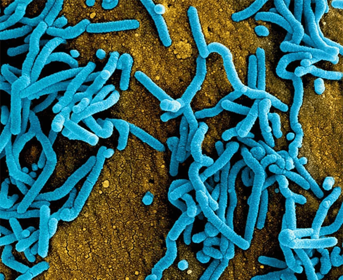Uganda Detects Severe Disease Amid Ebola Outbreak: WHO